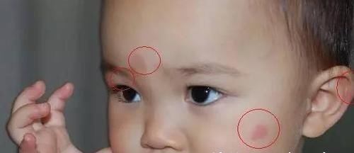 止痒|儿科医生忠告:宝宝被蚊虫叮咬后,家长不要再这样做了