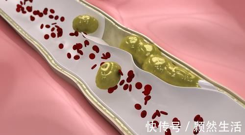 体检|体检查出颈动脉斑块必须吃药？医生：比起吃药，还有件事同样重要