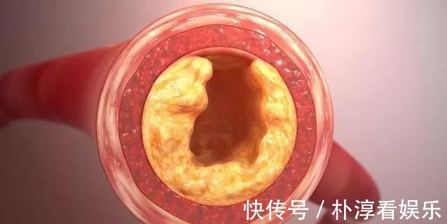 堵塞|45岁后,血管加速老化,5类食物,尽量少吃,血管承受不了