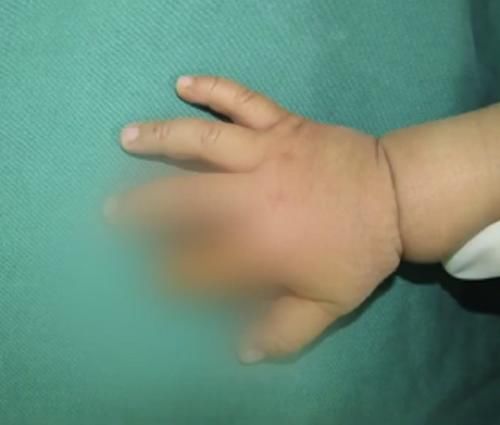  兔子|1岁男童被兔子咬断手指，家人杀兔取指为时已晚，表示3天没喂过