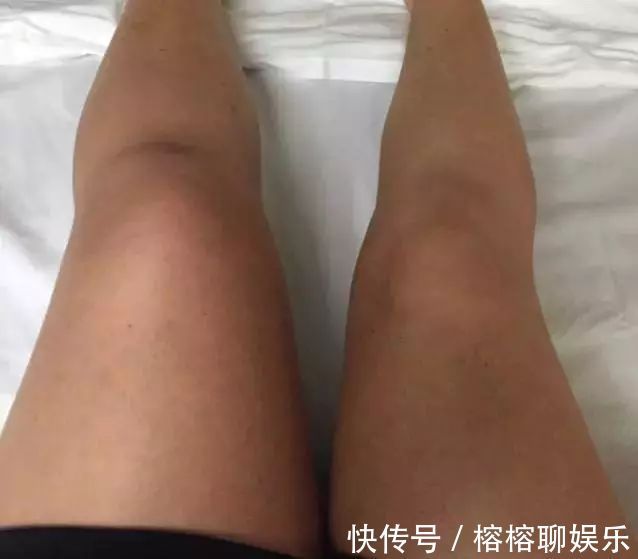 下肢|血栓形成后,腿脚容易出现4个异常,若一个没有,血管还算通畅