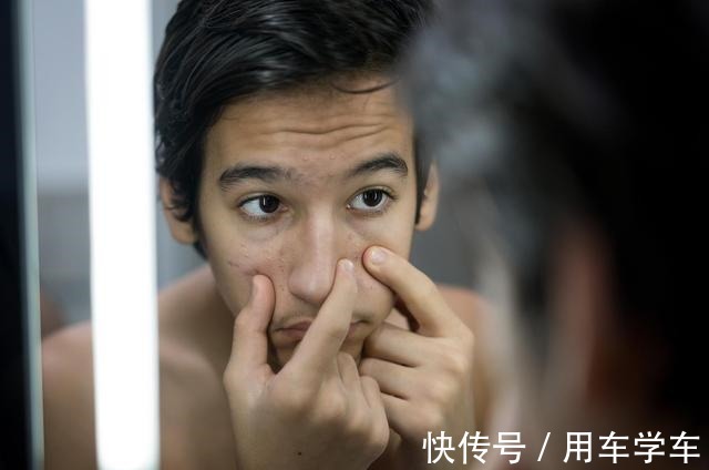 祛痘 长痘痘了不要挤 多种医美能帮你!