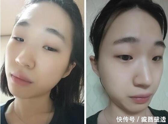 小脸|小脸确实更可爱,看完整容过程,只觉得满屏的疼痛