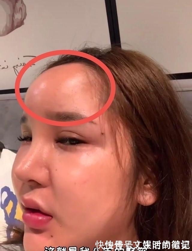巅峰照 8年的整形手术花费了100多万，光额头就打了200多支玻尿酸