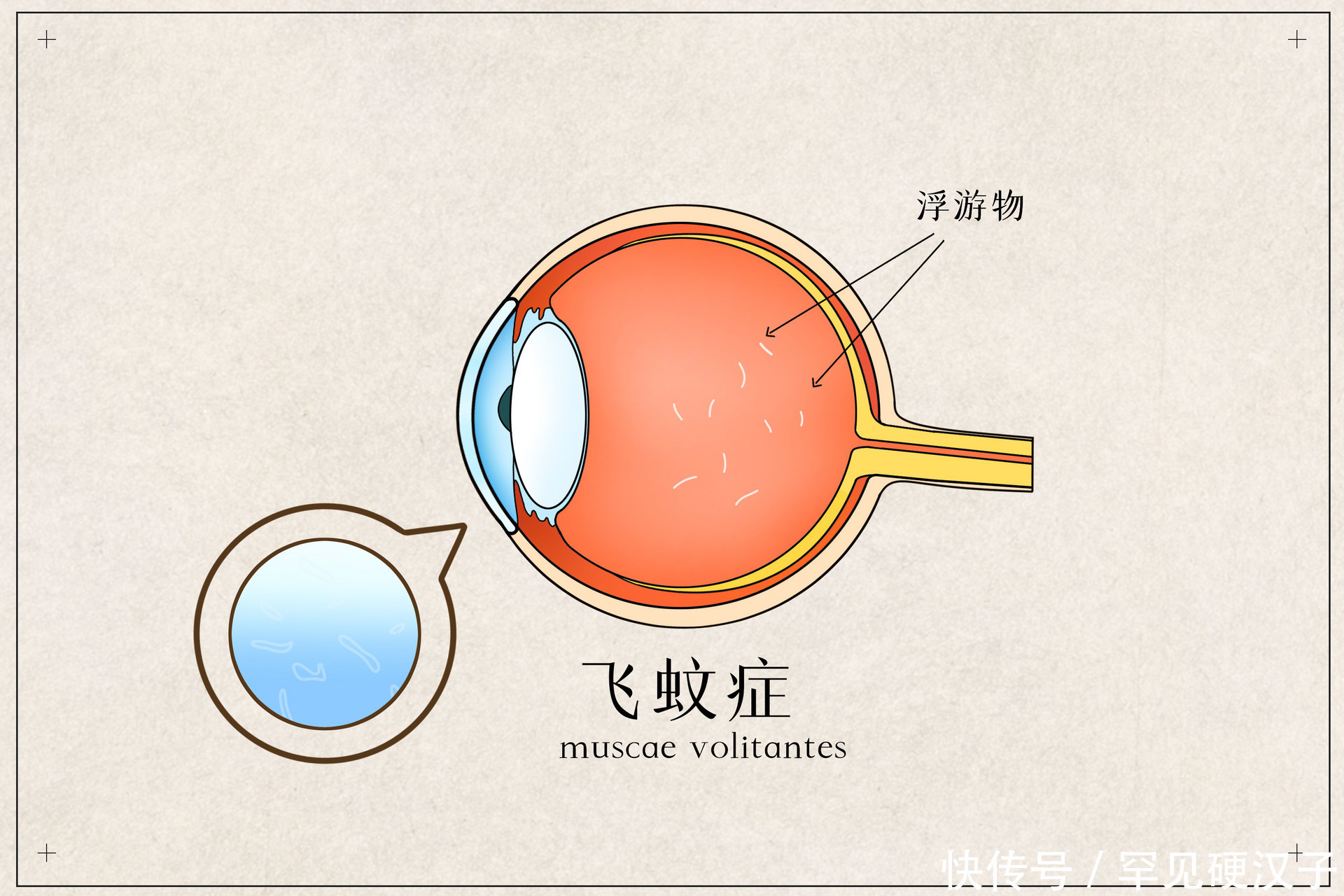  蚊子|眼睛总是看到蚊子，如何治疗有3种治疗方法，可以帮到你