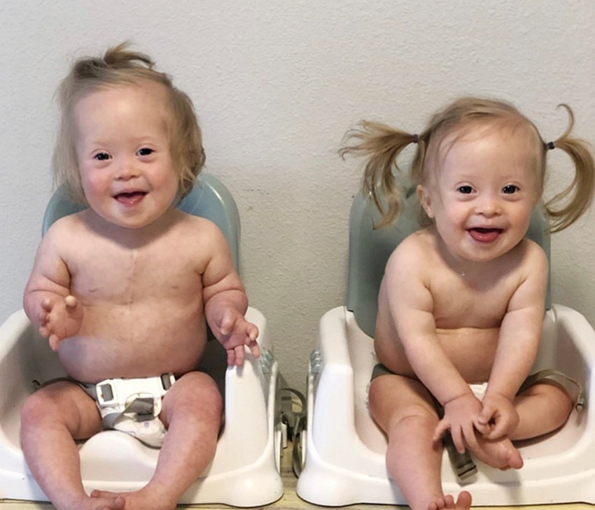 病症|产妇生下唐氏双胞胎姐妹,并没有放弃,网友唐宝都有一张国际脸