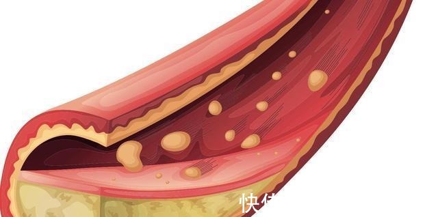 心脑血管疾病|多位院士呼吁90血栓或无需治疗,记住两个词,一生无栓!