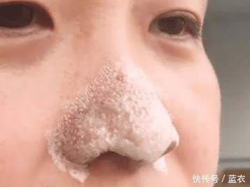 皮肤|鼻上黑头别傻傻再用手挤,皮肤科医生教你一招,让黑头自动流出来!