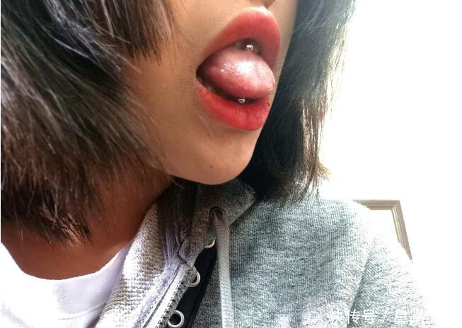 舌钉增生是什么样子图片