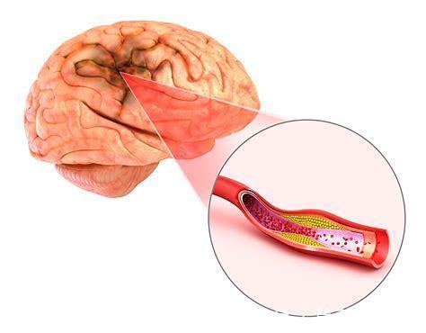 脑梗死|为什么脑梗死容易复发，有什么办法可以预防？医生为您讲清楚