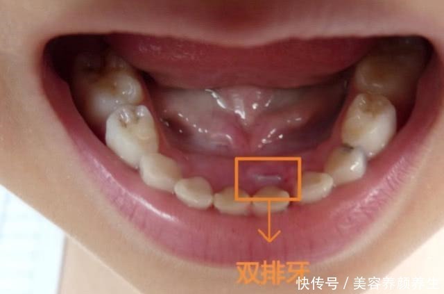 轩轩|7岁男孩长出“双排牙”,要一颗一颗拔掉,奶奶自责不已,赖我啊!