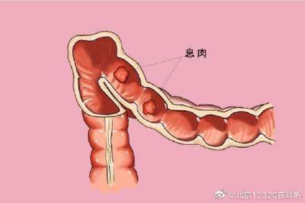 肠息肉|体检查出结肠息肉一定需要治疗吗？