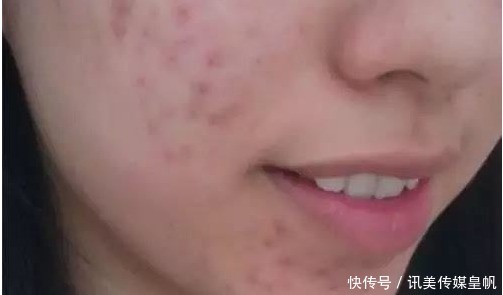 黑头|鸡蛋清能去黑头?医生提醒:2招轻松搞定草莓鼻烦恼