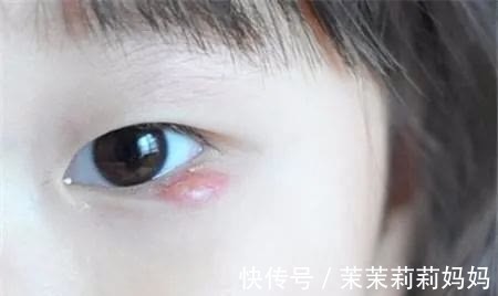 包包|孩子眼皮上长包,不痛不痒,一直消不下去?说明这里出了问题!