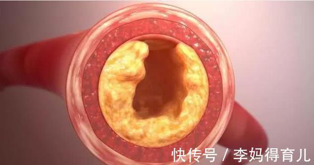 秋天|高血脂患者秋天能吃葡萄吗？若想稳定血脂，建议多吃5种水果