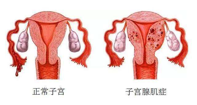 腺肌症|贝安：子宫腺肌症可以自然怀孕吗？