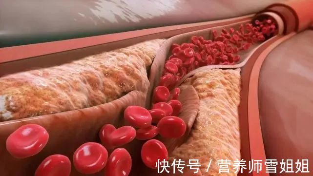 超标|一旦出现4种迹象,说明血脂“超标”了,需给血管“洗洗澡”了