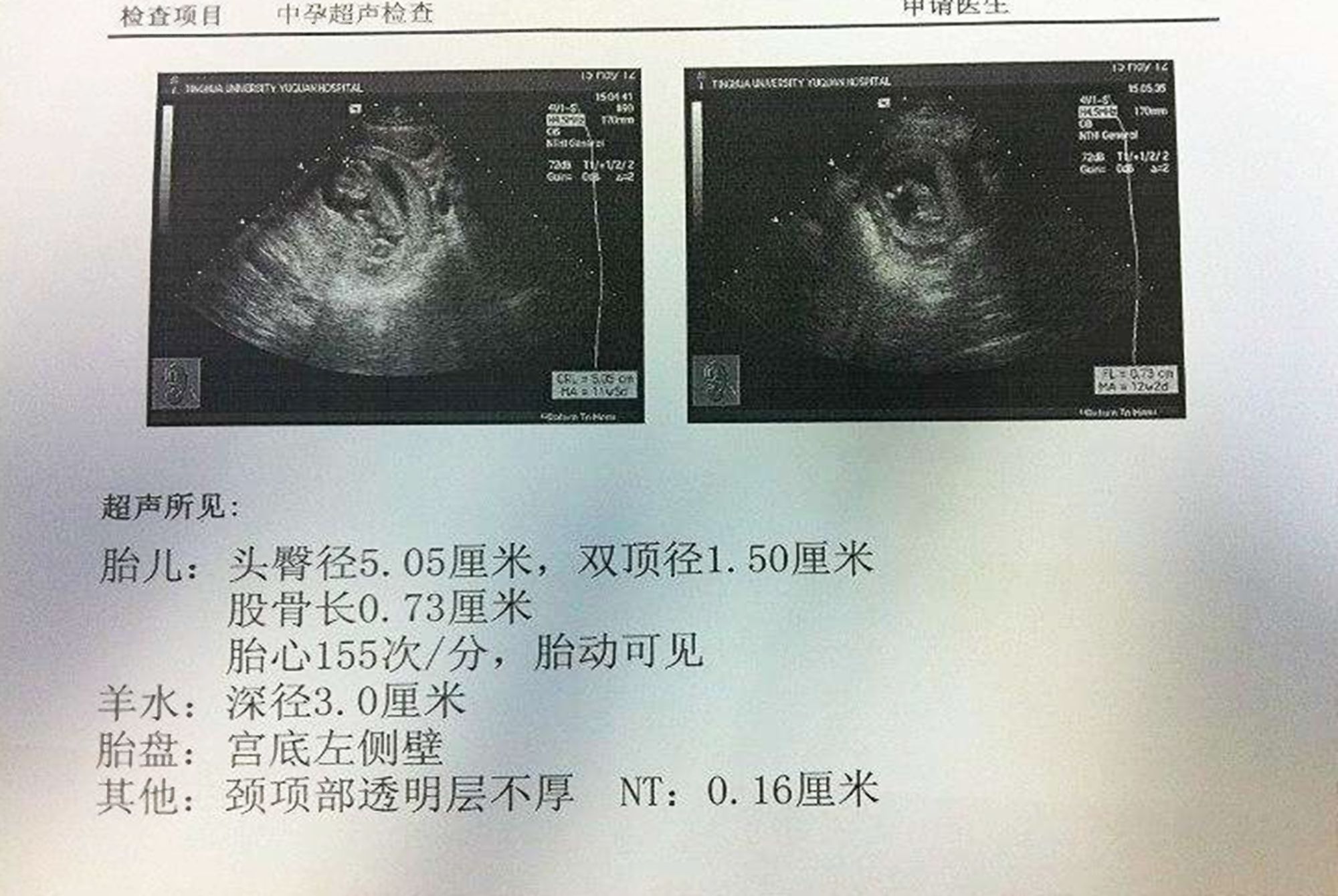 b超检查|B超单上有两个数据,透露胎儿长大后的身高,宝妈早了解早做准备