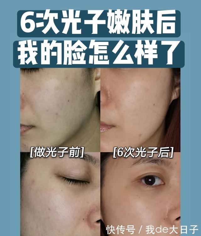 光子嫩肤 6次光子嫩肤后,我的脸怎么样了!