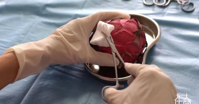 手术|给火龙果割阑尾33岁水果医生爆红吸粉90万网友看到第一个就痛了