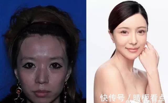 美白|实拍:10张女孩整容前后的对比照,这真就是换了一张脸