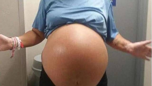 剖腹产|孕妇以为自己怀了双胞胎,剖腹产下宝宝后,宝妈太意外