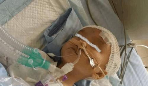 家长|1岁半宝宝出生时很健康,却因妈妈这一“善举”患脑瘫,别大意