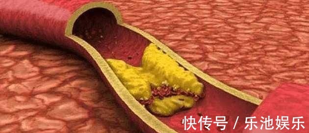 血管|血栓碰上“天敵”了! 常吃讓你血管通暢, 血壓血脂也正常了