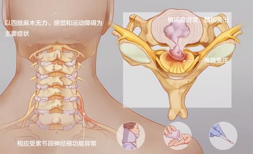 颈部|走路像脚踩棉花，是脑梗还是颈椎病？