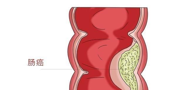  带血的症状|因大便带血，查出肠癌，医生提醒肠癌有3个征兆，别再当成痔疮