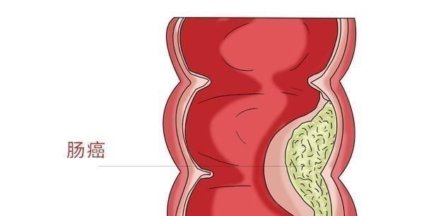 带血的症状|因大便带血,查出肠癌,医生提醒肠癌有3个征兆,别再当成痔疮