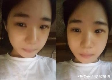 小脸确实更可爱,看完整容过程,只觉得满屏的疼痛