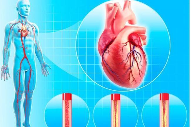 斑块|冠心病,是由什么原因引起来的?听听医生怎么说