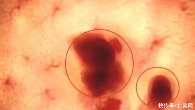 胃食管反流|胃病无小事，一不小心可能拖成癌！有这些迹象要及时就诊