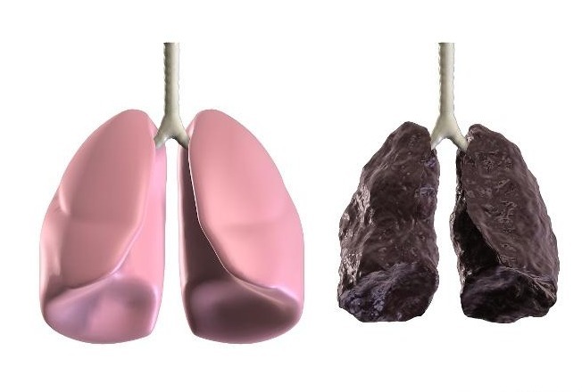 胳膊|“肺癌”早期，不止是干咳，身体还可能发出4个“警报”别忽视！