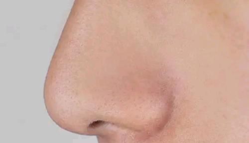 鼻子两侧的白色分泌物是什么东西?为何越挤越多?一起来了解一下