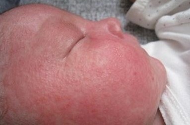 豌豆|新生儿宝贝长了好多湿疹,什么原因,2招教你快速搞定