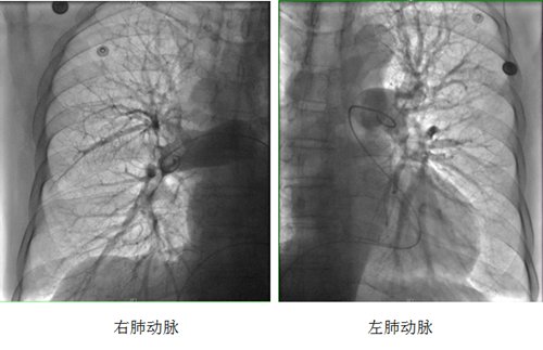 肺动脉|60岁男性活动性深静脉血栓合并高危肺栓塞，这个手术救他一命