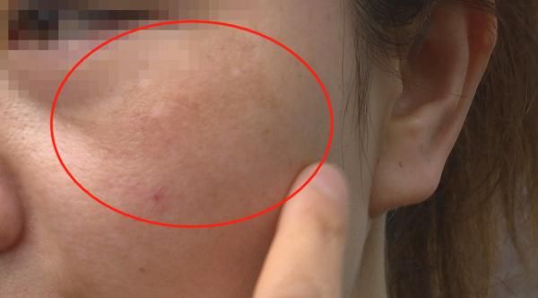 警惕！女子“变美”不成，弄成这样……