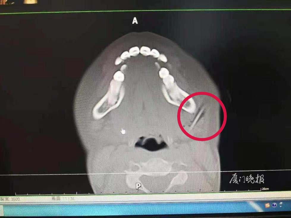 嘶！看着就疼！厦门11岁男孩脸上插进一支铅笔，只因这个小动作……