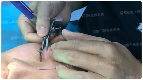 逼疯强迫症的一单一双眼皮，手术能不能只做单侧？