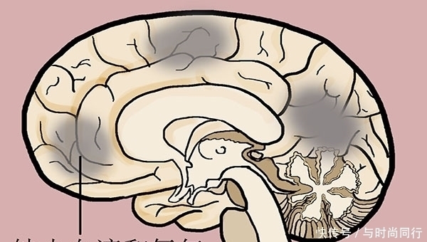 一个月|医生:脑梗其实很少“突发”,发作前一个月左右就有信号,别忽视