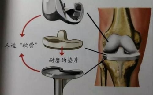 高跟鞋|膝关节疼痛难忍，直接影响正常工作生活，当膝关节损伤时该怎么办