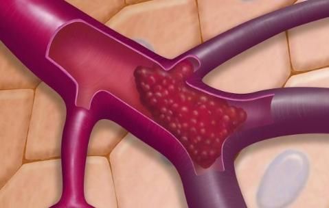 日常生活中|人体能否自动消除”血栓“?做好以下几件事,”血栓“形成不了