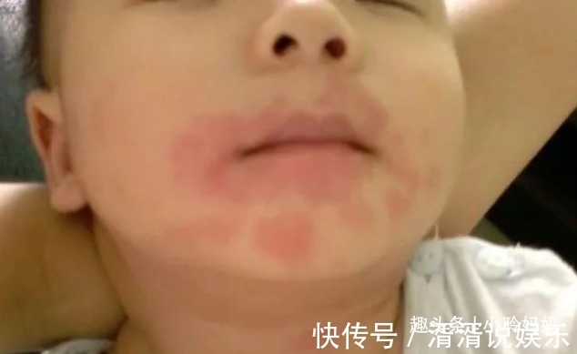 过敏原|为何不能给宝宝吃“鸡蛋羹”儿科医生劝诫多次，家长要听进去