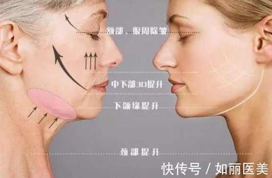 热玛吉 三大抗衰老项目:超声提升、热玛吉和线雕优缺点对比!该如何选择?