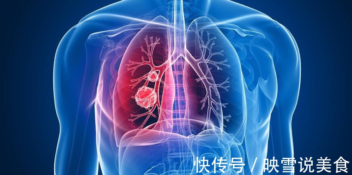 放疗|治癌二十多年,肺癌专家患上肺癌,他的一个反思,引人深思