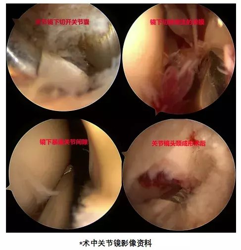 股骨头|运动健身要当心，小心“股髋撞击”惹上身