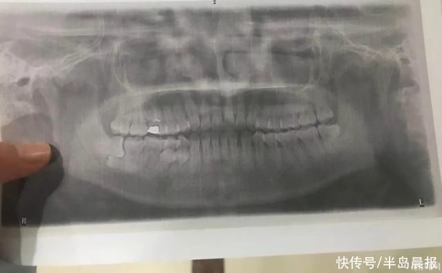  住院|姑娘住院4天，一次性拔了6颗牙?！网友：是个狠人