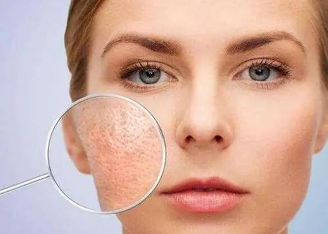 回事|毛孔粗大别不当回事,这几个问题需要注意,避免形成“马蜂窝”